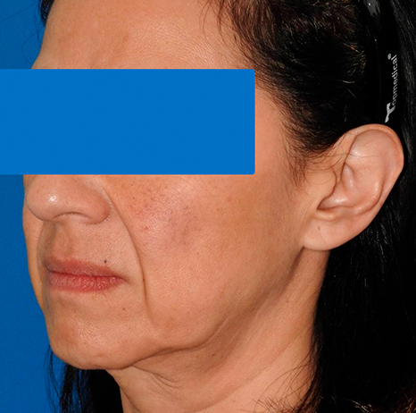 Lifting Facial En Veracruz, Ritidectomia